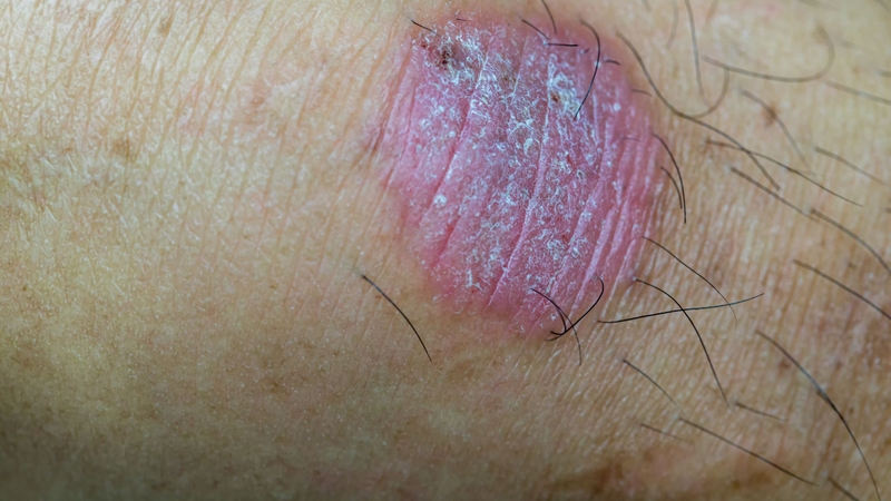 Thông thường, các vòng da bị lác có màu đỏ hồng, đỏ tía, nâu nhạt hoặc xám, thậm chí sẫm màu hơn ở giai đoạn bệnh kéo dài