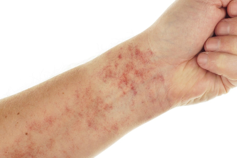 Hình ảnh lupus ban đỏ dạng đĩa thường xuất hiện như thế nào? Triệu chứng lâm sàng và cách điều trị 2
