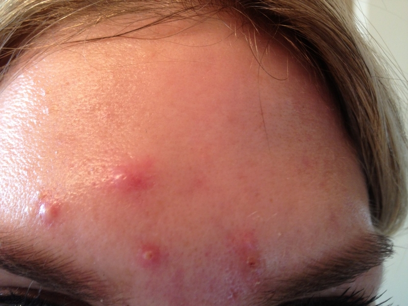 Mụn nội tiết xuất phát từ sự biến đổi hormone trong cơ thể