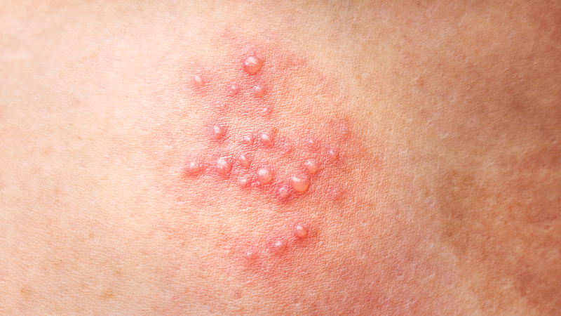 Hình ảnh mụn rộp sinh dục nữ: Hướng dẫn nhận diện, triệu chứng và điều trị 1