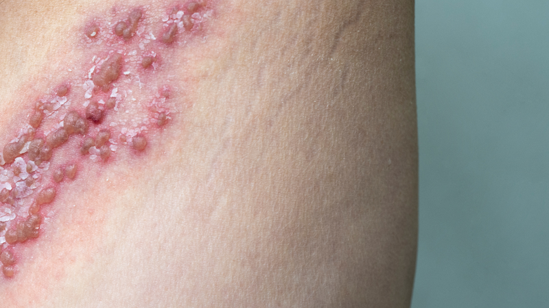 Hình ảnh mụn rộp sinh dục nữ: Hướng dẫn nhận diện, triệu chứng và điều trị 2