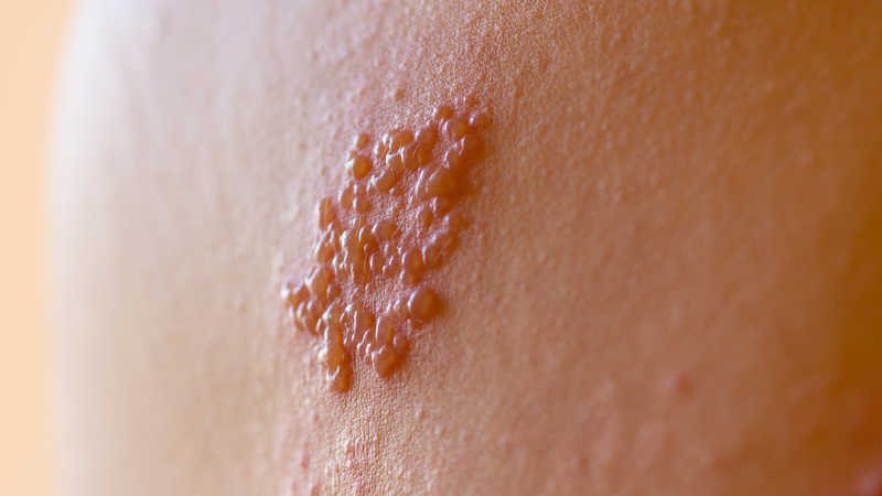 Hình ảnh mụn rộp sinh dục nữ: Hướng dẫn nhận diện, triệu chứng và điều trị 3