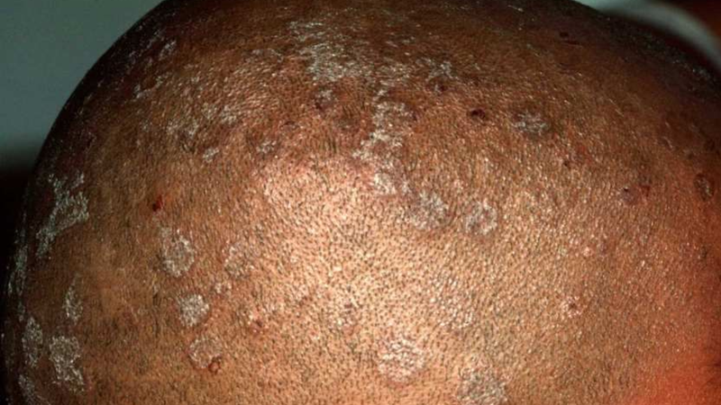 Hình ảnh nấm da đầu: Dấu hiệu dễ nhận biết, cách chữa và phòng ngừa 2