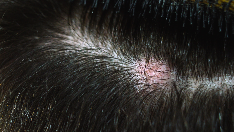 Hình ảnh nấm da đầu: Dấu hiệu dễ nhận biết, cách chữa và phòng ngừa 4