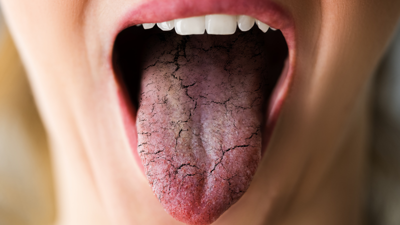 Hình ảnh nấm lưỡi ở người lớn dễ nhận biết và cách xử lý an toàn 2