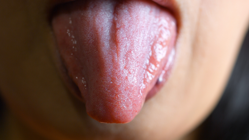 Hình ảnh nấm lưỡi ở người lớn dễ nhận biết và cách xử lý an toàn 3