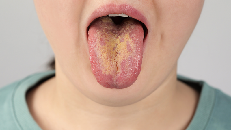 Hình ảnh nấm lưỡi ở người lớn dễ nhận biết và cách xử lý an toàn 4