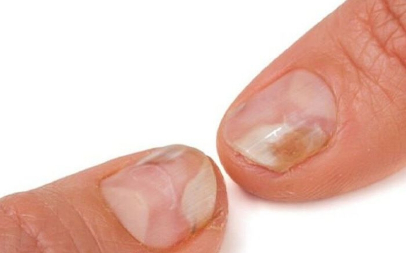 Những loại viêm da nhiễm trùng thường gặp trong cuộc sống 1