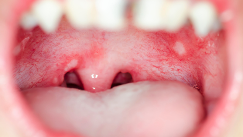 Nhận biết hình ảnh nhiệt miệng qua từng giai đoạn để chăm sóc đúng cách5