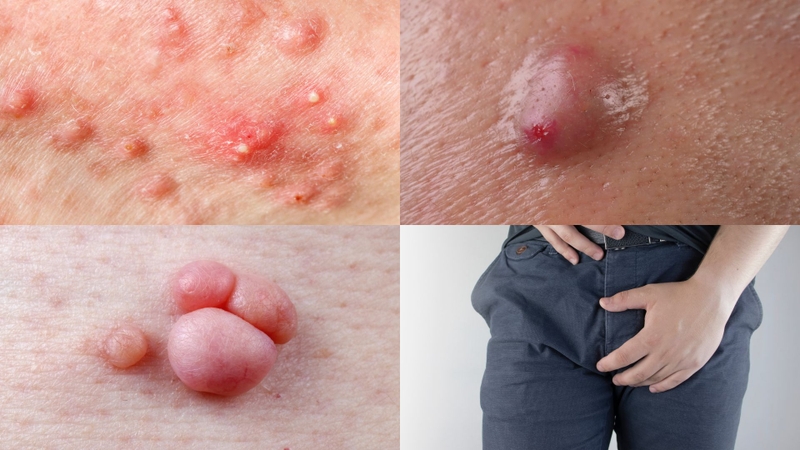 Hình ảnh nổi mụn ở vùng kín nam: Nhận biết để có phương án điều trị kịp thời! 1