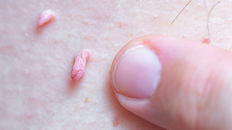 Hình ảnh nổi mụn ở vùng kín nam: Nhận biết để có phương án điều trị kịp thời! 2