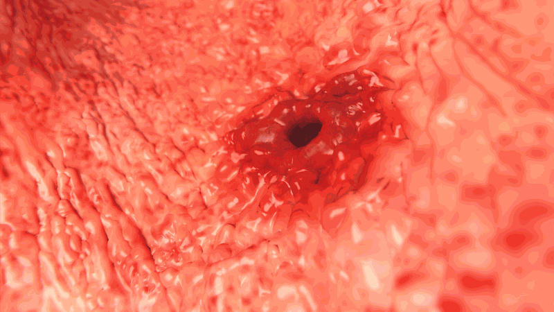 Hình ảnh nội soi dạ dày giúp các bác sĩ dễ dàng nhận diện các vấn đề liên quan đến dạ dày