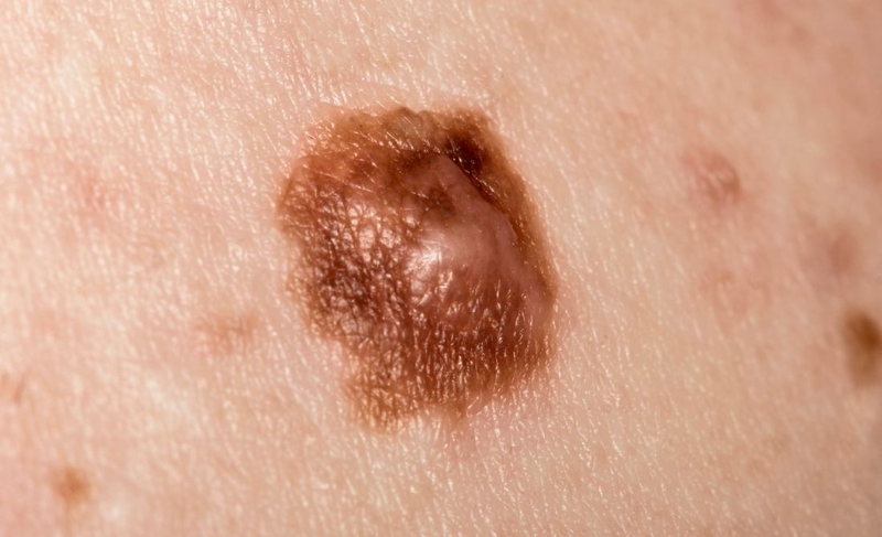 Dấu hiệu nhận biết hình ảnh nốt ruồi ung thư hắc tố 1