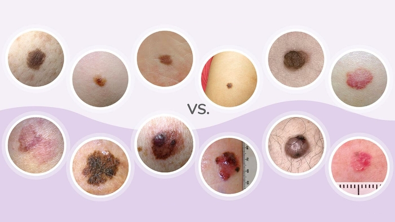 Dấu hiệu nhận biết hình ảnh nốt ruồi ung thư hắc tố 2