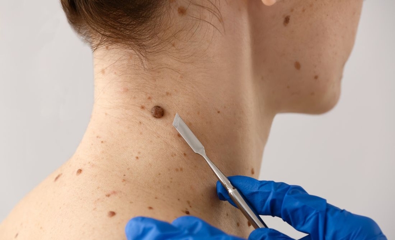 Dấu hiệu nhận biết hình ảnh nốt ruồi ung thư hắc tố 4