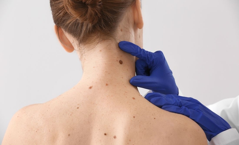 Dấu hiệu nhận biết hình ảnh nốt ruồi ung thư hắc tố 3