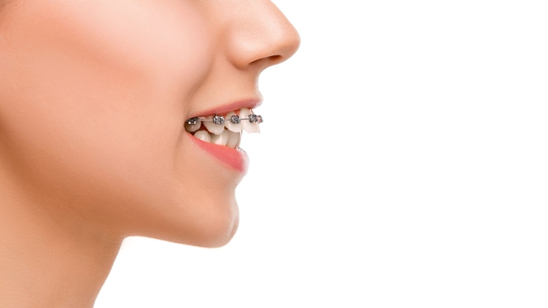 Hình ảnh răng hô nhẹ cùng giải pháp cải thiện 3