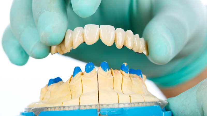 Hình ảnh răng hô nhẹ cùng giải pháp cải thiện 4