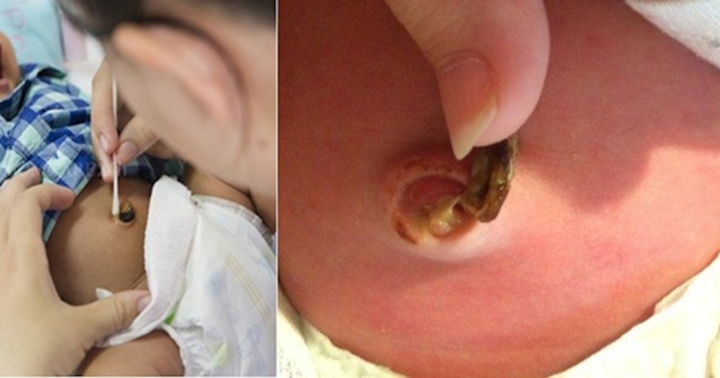 Hình ảnh rốn trẻ sơ sinh bị nhiễm trùng cùng cách điều trị nhiễm trùng rốn mẹ cần biết 2