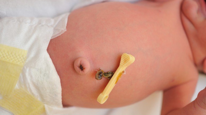 Hình ảnh rốn trẻ sơ sinh bình thường và cách chăm sóc rốn sau rụng 2