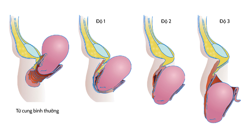 Hình ảnh sa tử cung độ 1: Dấu hiệu nhận biết và cách trị 2