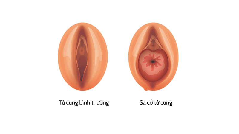 Hình ảnh sa tử cung độ 1: Dấu hiệu nhận biết và cách trị 4