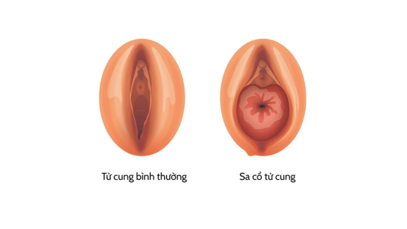 Hình ảnh sa tử cung độ 2: Dấu hiệu nhận biết và cách điều trị 1