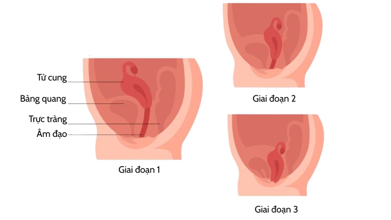 Hình ảnh sa tử cung độ 2: Dấu hiệu nhận biết và cách điều trị 2