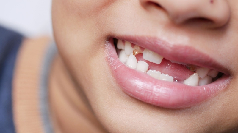 Hình ảnh sâu răng ở trẻ em và cách phòng ngừa sâu răng hiệu quả4