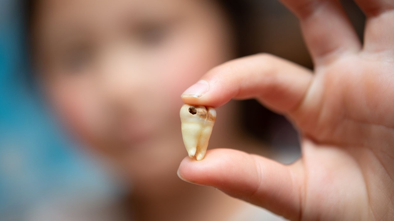 Hình ảnh sâu răng ở trẻ em và cách phòng ngừa sâu răng hiệu quả5