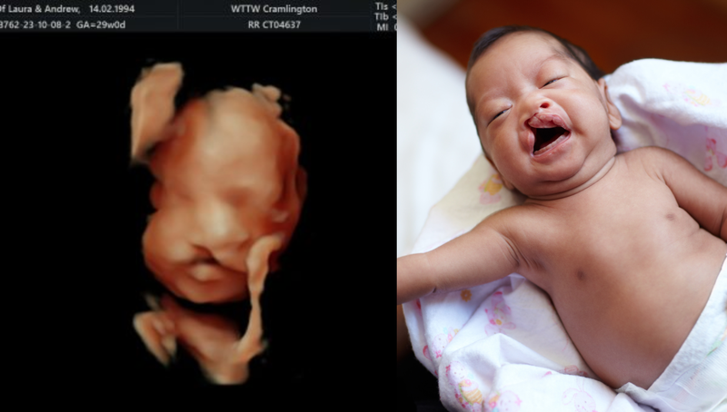 Hình ảnh siêu âm thai nhi bị hở hàm ếch: Phát hiện và quản lý dị tật bẩm sinh 1