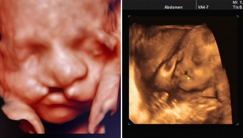 Hình ảnh siêu âm thai nhi bị hở hàm ếch: Phát hiện và quản lý dị tật bẩm sinh 2
