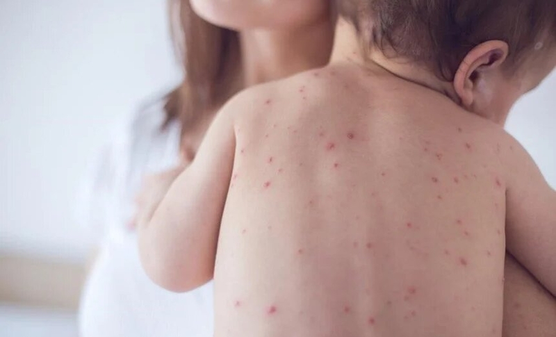 hinh-anh-sot-phat-ban-o-tre-em-ma-bo-me-nen-biet 4.jpg