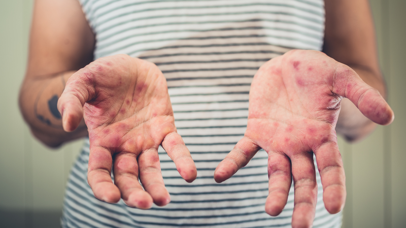 Hình ảnh tay chân miệng ở người lớn trong giai đoạn toàn phát