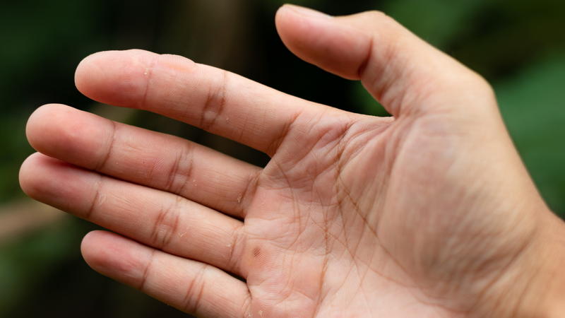 Vào giai đoạn hồi phục, các vết mụn nước sẽ từ từ biến mất sau khoảng 7 - 10 ngày