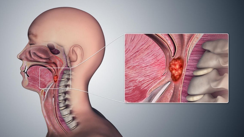 Người bệnh không nên tự đánh giá tính chất của khối u thông qua hình ảnh