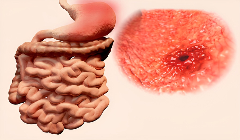 Hình ảnh ung thư dạ dày qua nội soi: Những dấu hiệu nhận biết sớm 2