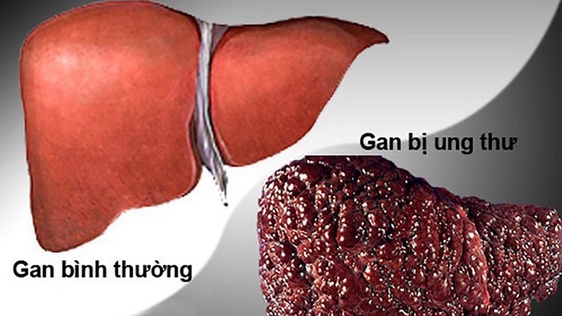 Một số đặc điểm của hình ảnh ung thư gan nguyên phát và thứ phát 2