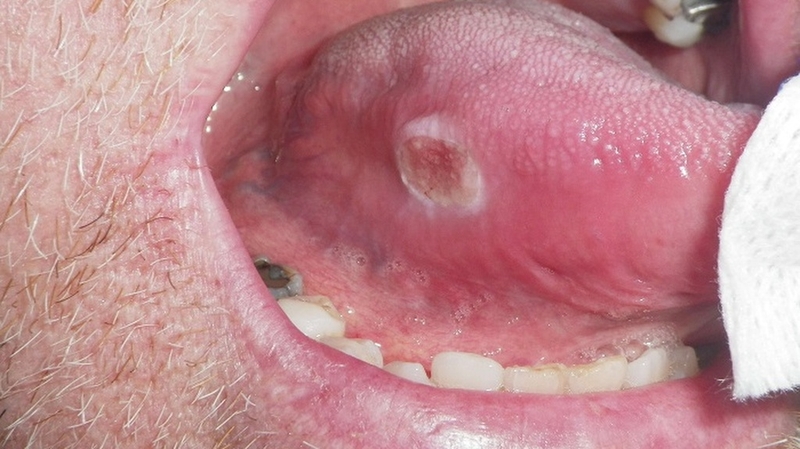Hình ảnh ung thư khoang miệng giai đoạn đầu: Dấu hiệu nhận biết sớm và cách phòng ngừa  1