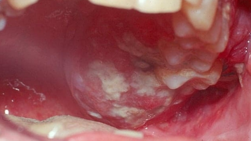 Hình ảnh ung thư khoang miệng giai đoạn đầu: Dấu hiệu nhận biết sớm và cách phòng ngừa  2