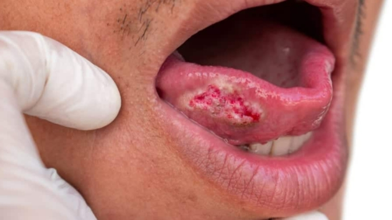 Hình ảnh ung thư khoang miệng giai đoạn đầu: Dấu hiệu nhận biết sớm và cách phòng ngừa  3