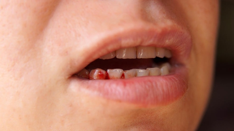 Hình ảnh ung thư khoang miệng giai đoạn đầu: Dấu hiệu nhận biết sớm và cách phòng ngừa 4