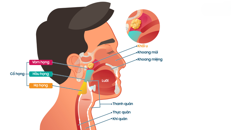 Hình ảnh ung thư vòm họng giai đoạn 1: Dấu hiệu và cách điều trị 1