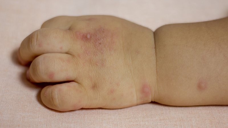 Các nốt ban đỏ hoặc mụn nước nhỏ là dấu hiệu dấu hiệu tay chân miệng nhẹ