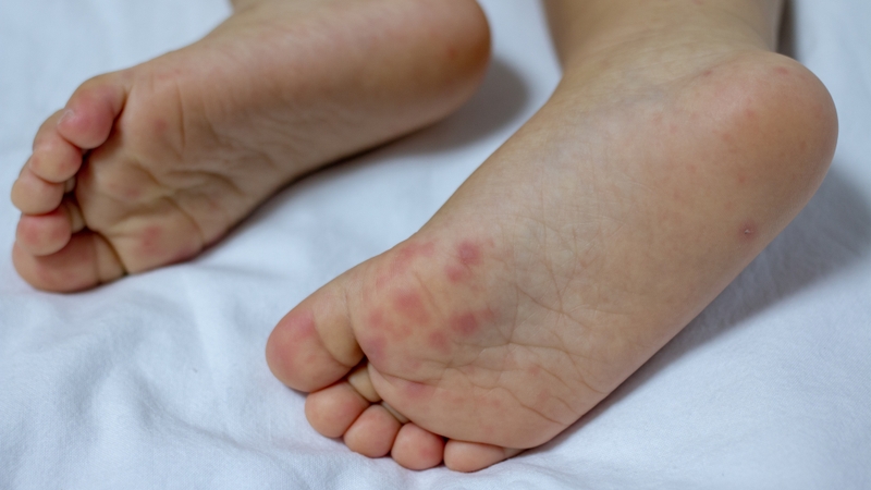 Có các nốt ban đỏ hoặc mụn nước nhỏ, không tụ mủ, rải rác, thường không gây đau nhiều