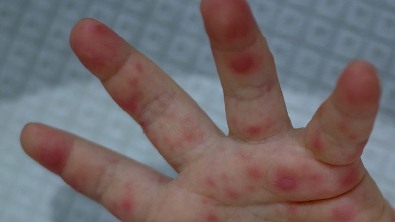 Bệnh có khả năng tiến triển nhanh sang các cấp độ nặng hơn, đặc biệt trong 3 - 5 ngày đầu khởi phát