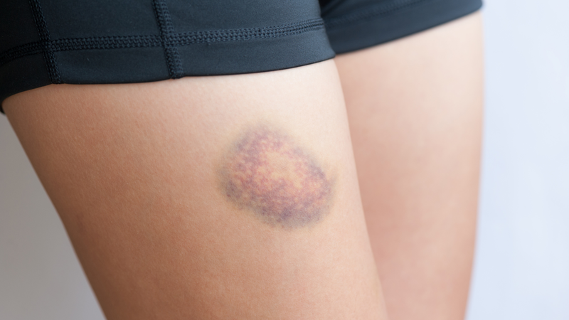 Vết bầm tím trên chân có thể thay đổi theo thời gian