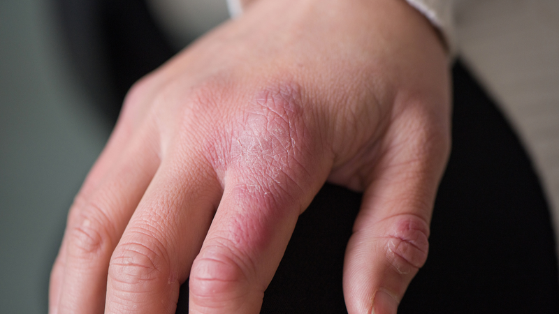 Hình ảnh viêm da cơ địa người lớn: Nguyên nhân và cách điều trị 4