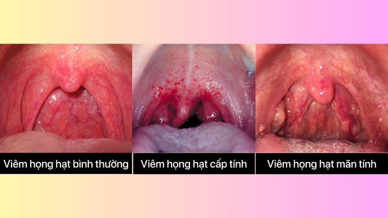 Hình ảnh viêm họng hạt ở cuống lưỡi 3