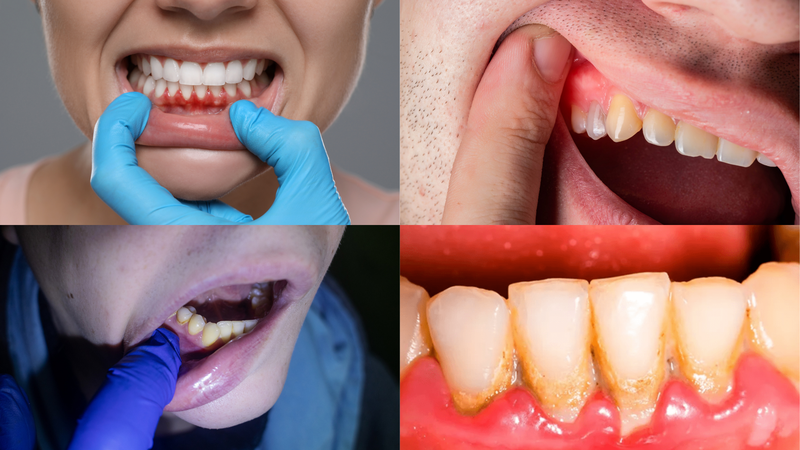 Hình ảnh viêm nướu răng giúp nhận biết bệnh sớm 1